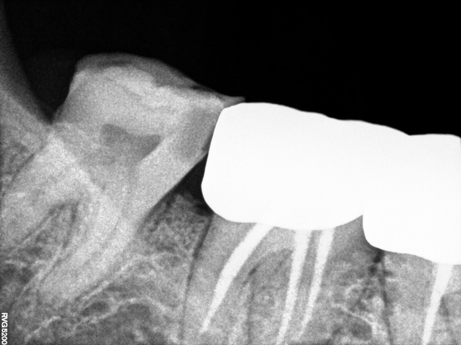 Dental X-ray